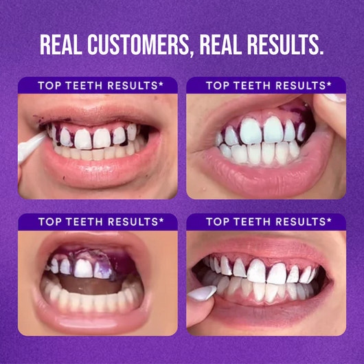 The Purple Company's Teeth Whitening Strips (Pack of 2 - 14 treatments)